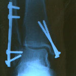 X-ray of a broken foot after ski accident
